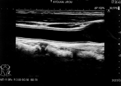 頚動脈超音波検査
