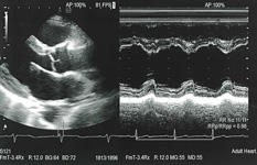 心臓超音波検査