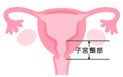 頸がん部位